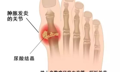 权威胆结石术引流管病人自行拔掉会怎么样平台,分享专业胆结石引流管脱落有危险吗知识_胆结石术引流管病人自行拔掉网